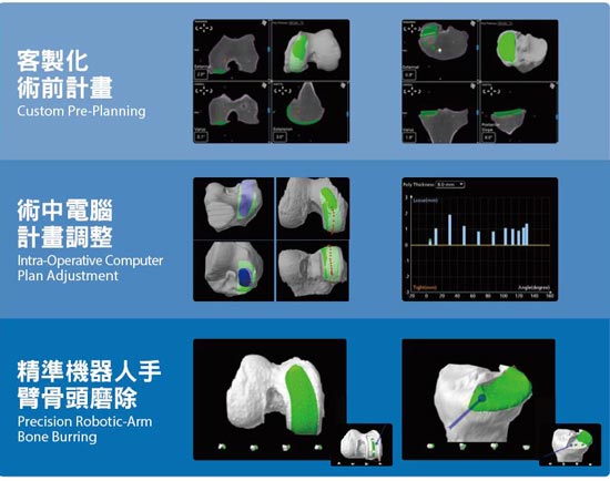 客製化術前計畫、術中電腦計畫調整、精準機器人手臂骨頭磨除